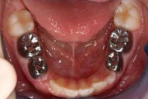 Stainless Steel Crowns