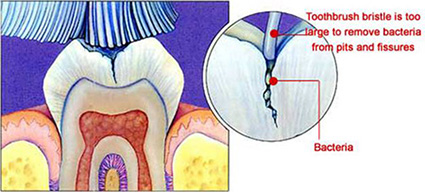 Dental sealant illustration