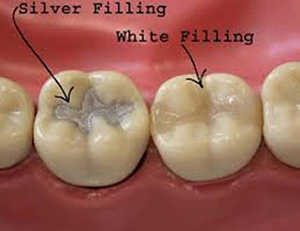 Fillings photo