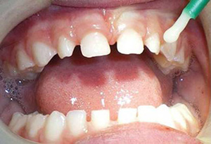 Fluoride Varnish photo