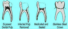 Pulp treatment chart