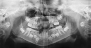 Radiographs (X-Rays)